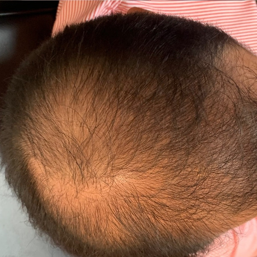 Zona frontal y Coronilla, Mes 0